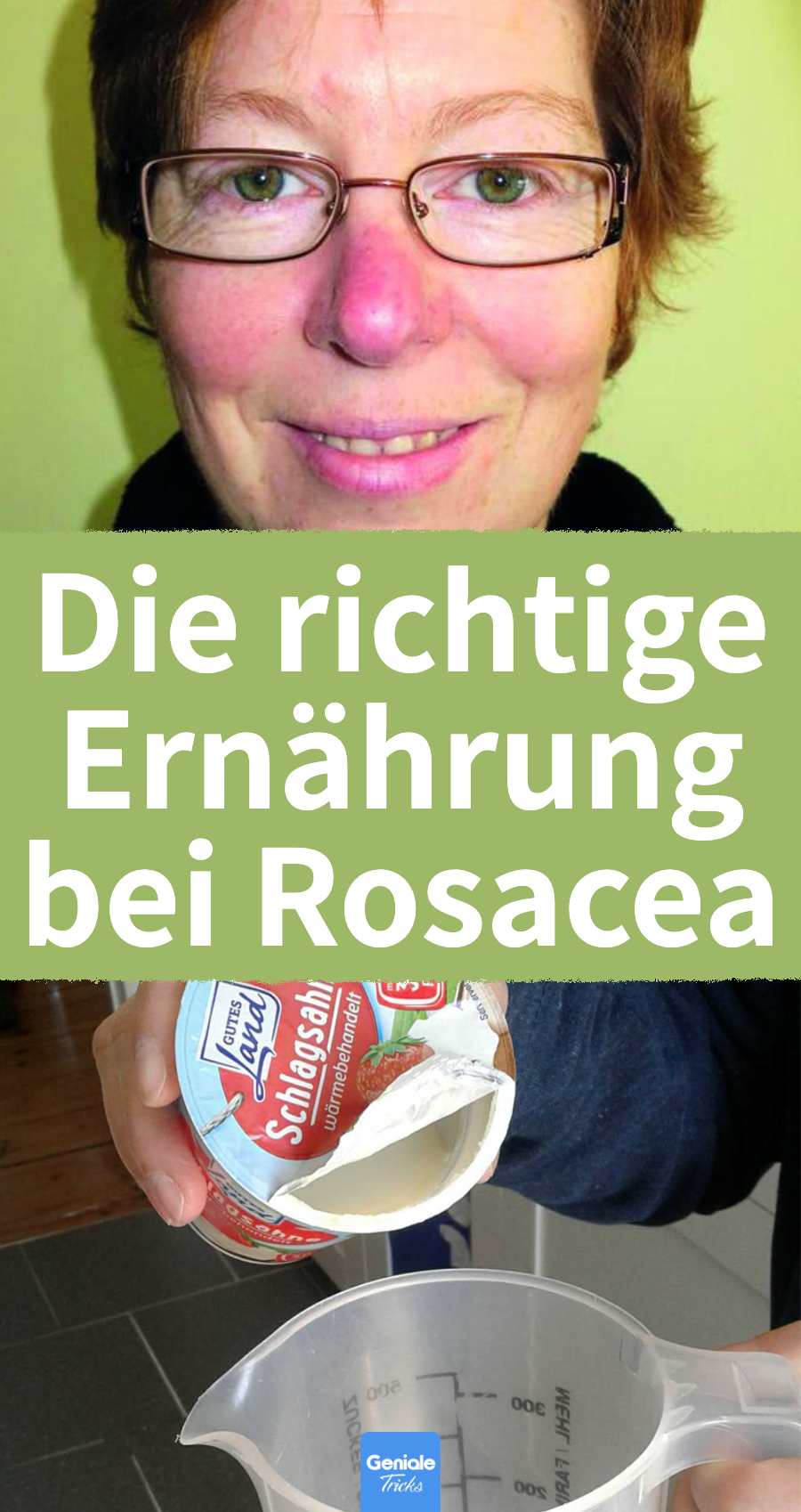 Rosacea Ernährung: 6 Nahrungsmittel, auf die man verzichten sollte